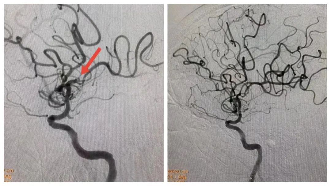 少见！急性心梗合并脑梗，3 小时 2 场手术接力「挽狂澜」