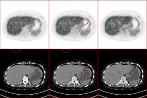 高尚病例：胃 MALT 淋巴瘤 18F-FDG PET/CT 表现及临床价值