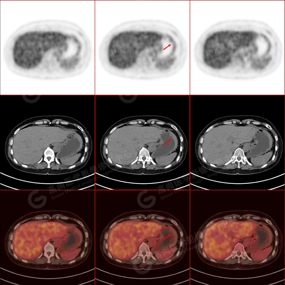 腋下淋巴癌早期症状图片 注意淋巴癌3症状_华夏智能网