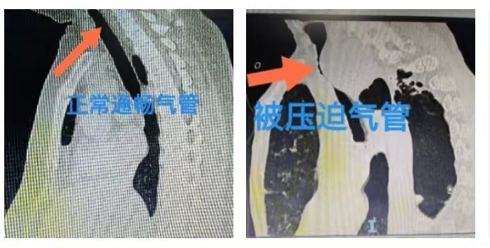 广西壮族自治区人民医院支气管支架置入术为患者支撑起生命气道