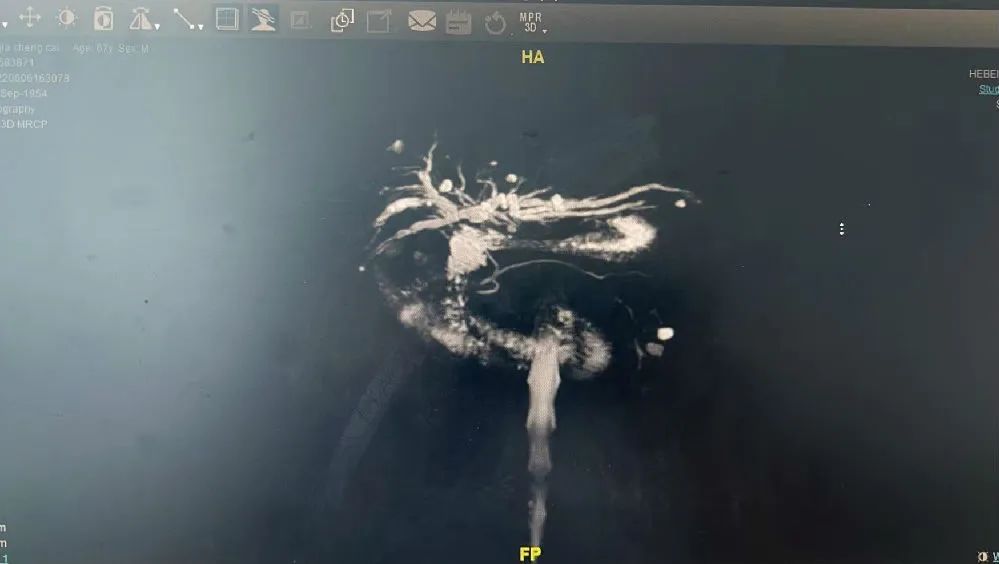 肝门部胆管癌不再是难题,燕达医院普外科摘得「皇冠上的明珠」