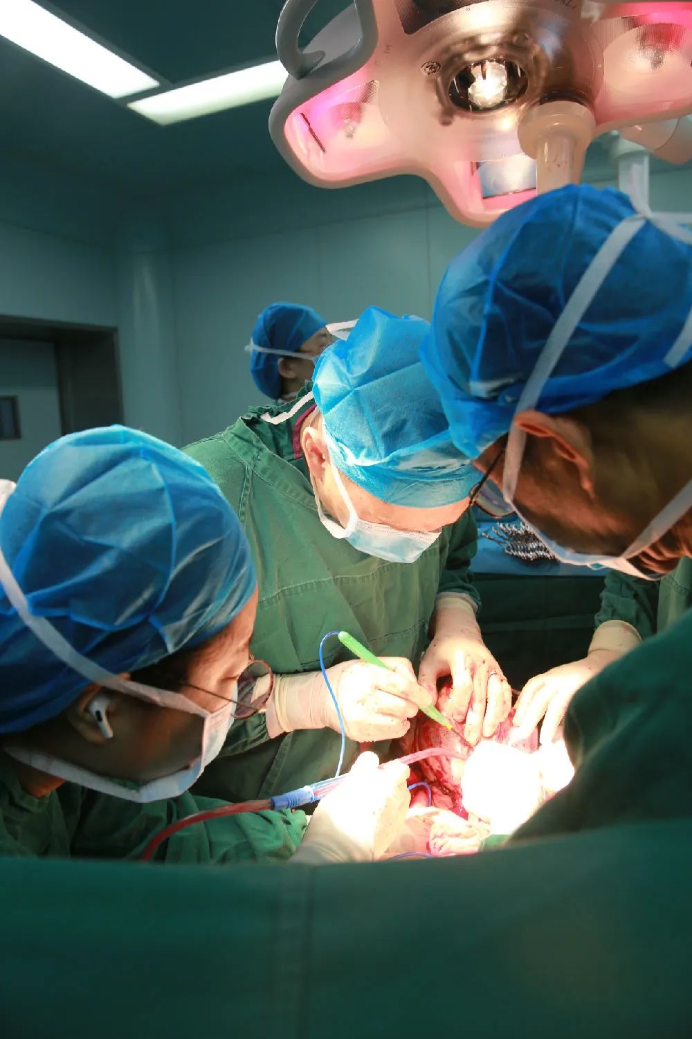 肝门部胆管癌不再是难题,燕达医院普外科摘得「皇冠上的明珠」