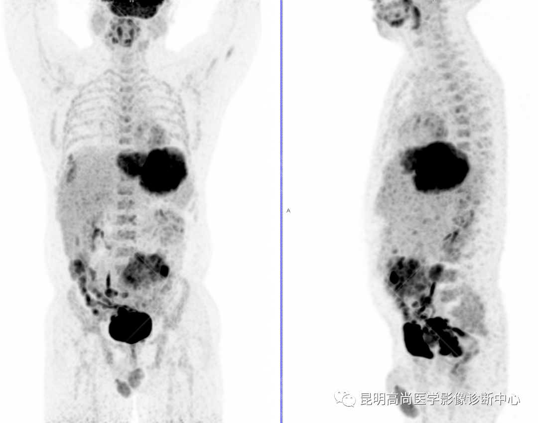高尚病例：胃肠道间质瘤一例