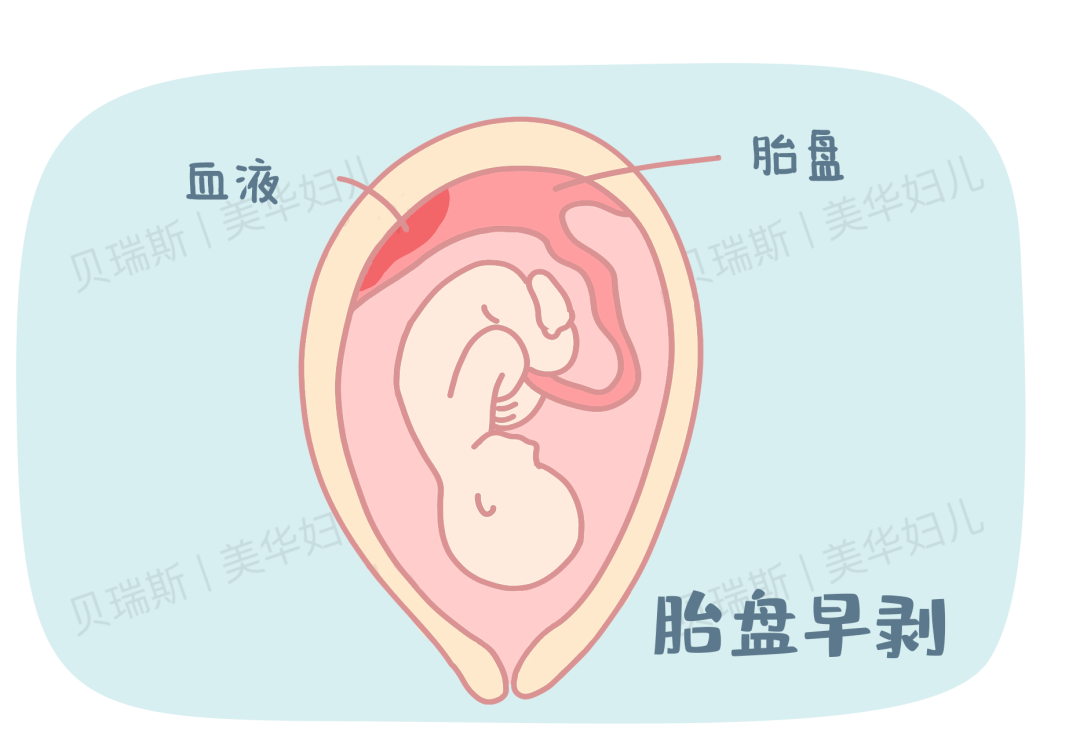 凶险！「胎盘早剥」突发出血！杭州美华医护全力守护，竟能成功顺产