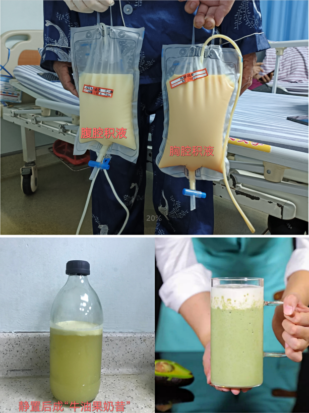 腹部充满牛奶样积液 | 广西壮族自治区人民医院介入微创手术为患者消除烦恼