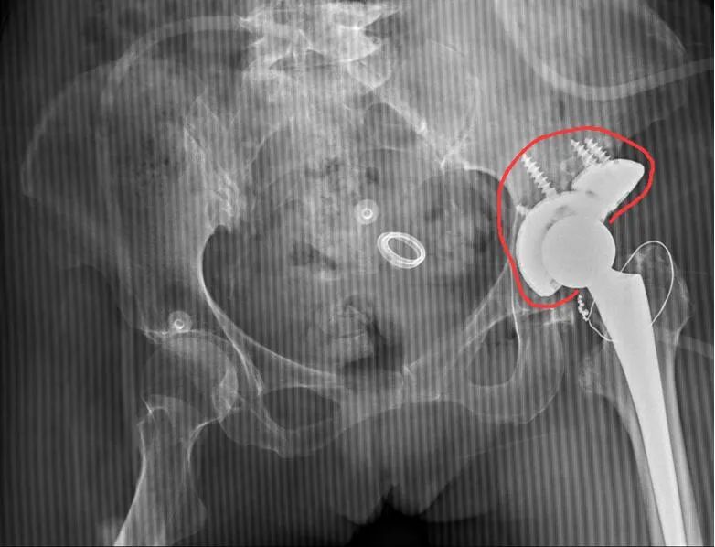 桂医附院脊柱骨病外科为一小儿麻痹症合并先髋股骨头坏死患者实施全髋关节置换手术