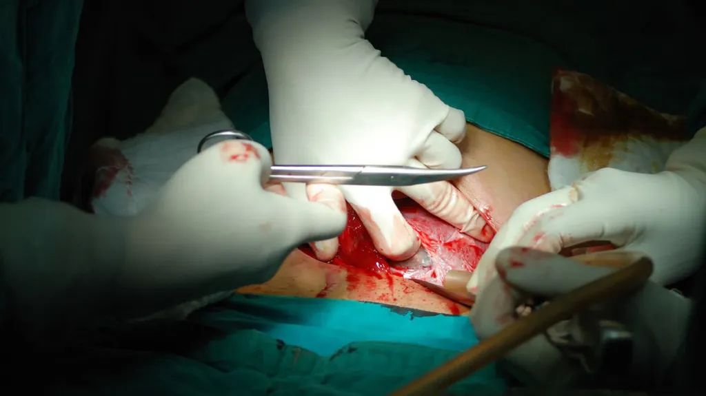 腹式全子宫切除术步骤图片