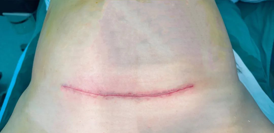 剖宫产手术切口图片