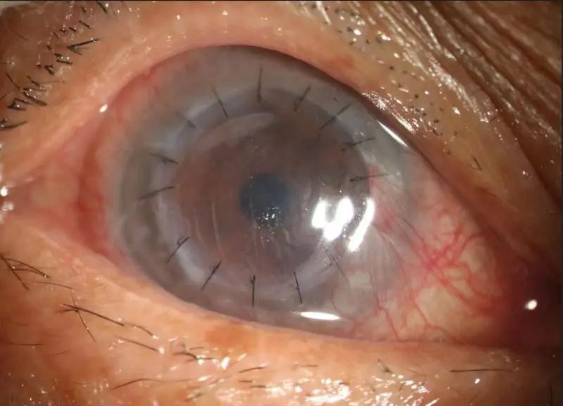上海市同济医院眼科完成首例术中 OCT 联合微型角膜刀辅助低温保存角膜移植术