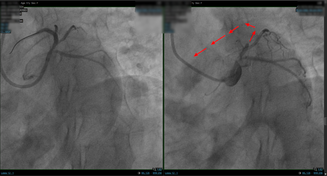 两天三例急性心梗！这位患者的做法让人感叹不已