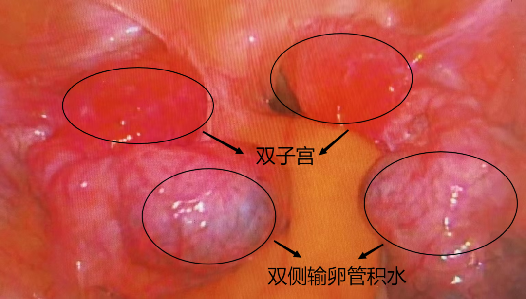 双子宫、双宫颈、高龄孕妇!怀孕到生产,西安大兴医院妇科产科联合护航迎健康宝宝