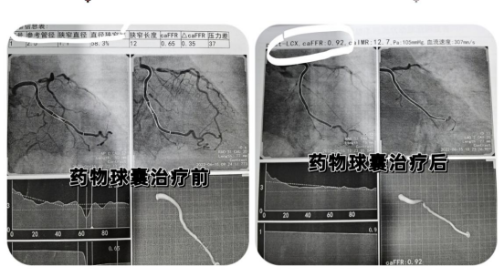 聚焦心血管/血流储备分数（FFR）在冠脉介入诊疗技术中的应用