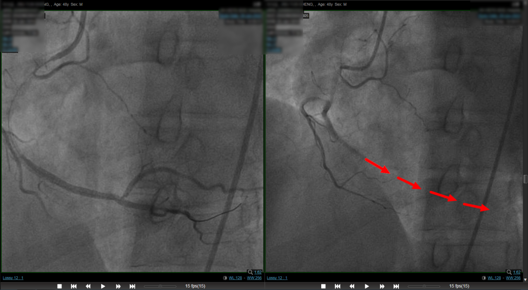 两天三例急性心梗！这位患者的做法让人感叹不已