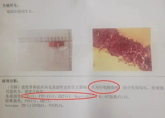 高尚病例：PET/CT 病例：原发性肺印戒细胞癌 1 例