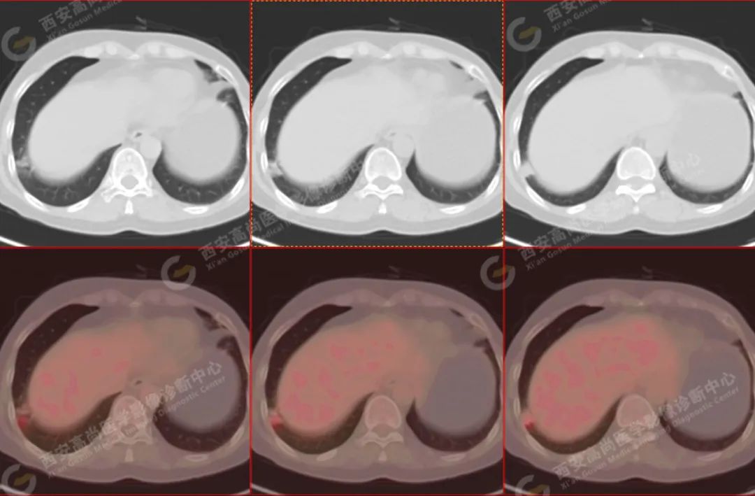 高尚病例：PET/CT 病例：原发性肺印戒细胞癌 1 例