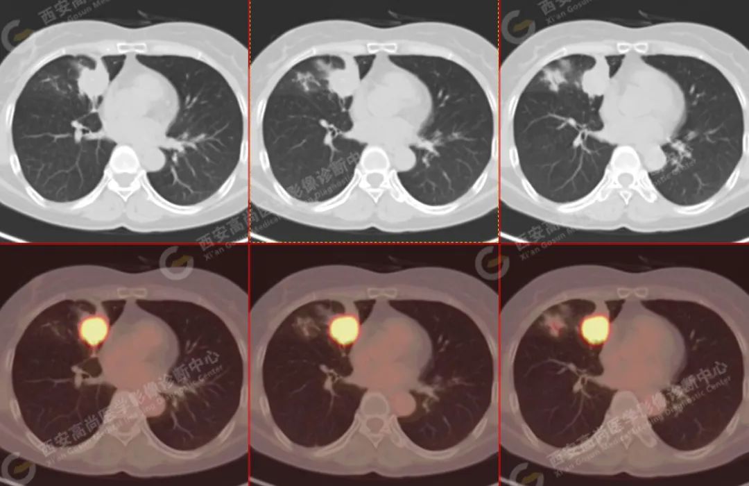 高尚病例：PET/CT 病例：原发性肺印戒细胞癌 1 例