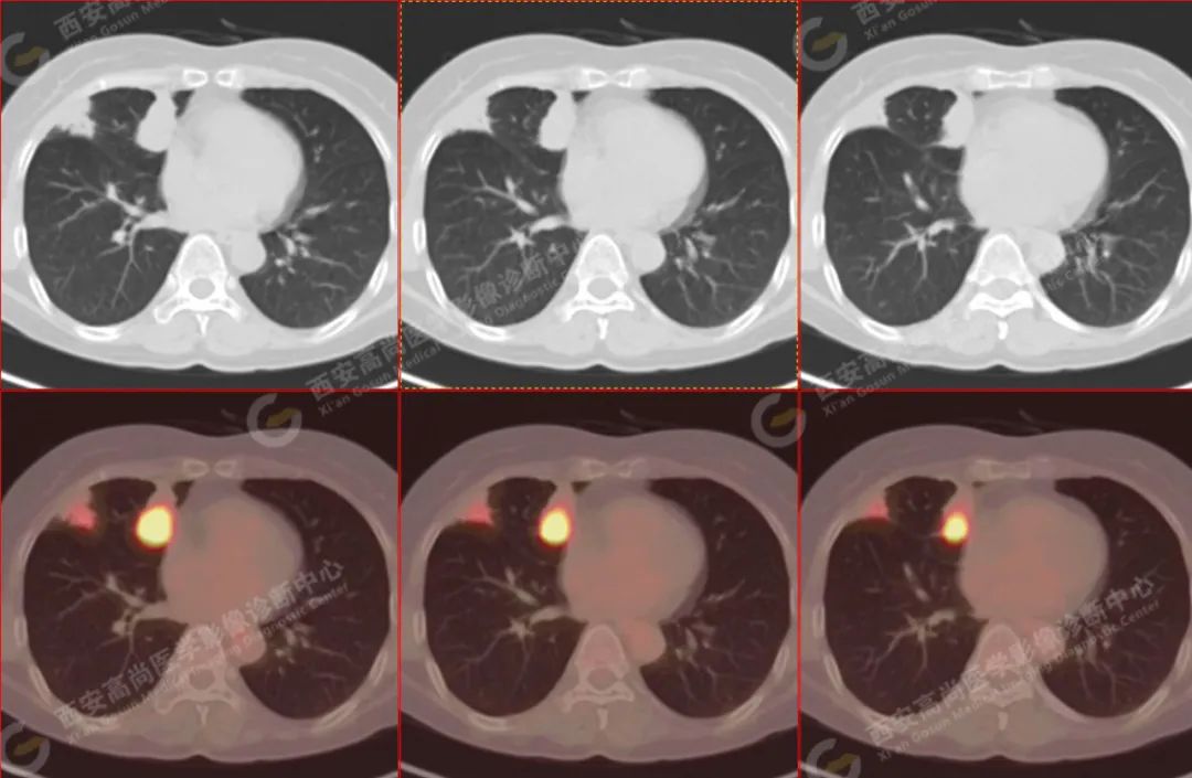 高尚病例：PET/CT 病例：原发性肺印戒细胞癌 1 例