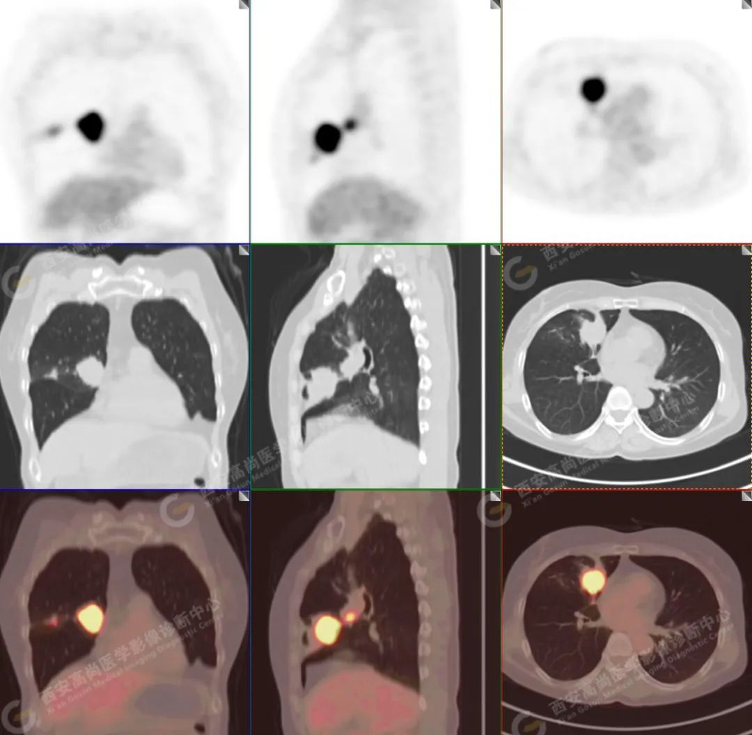 高尚病例：PET/CT 病例：原发性肺印戒细胞癌 1 例