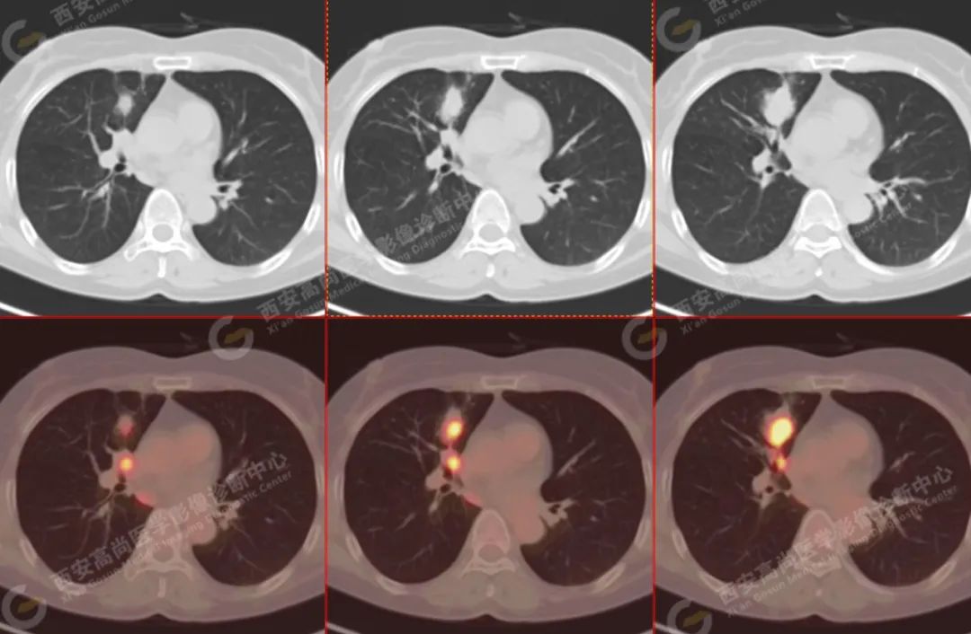 高尚病例：PET/CT 病例：原发性肺印戒细胞癌 1 例