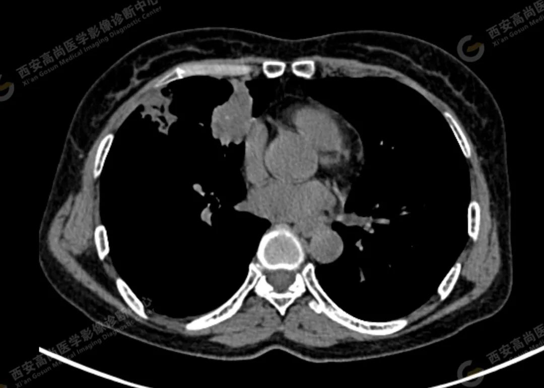 高尚病例：PET/CT 病例：原发性肺印戒细胞癌 1 例