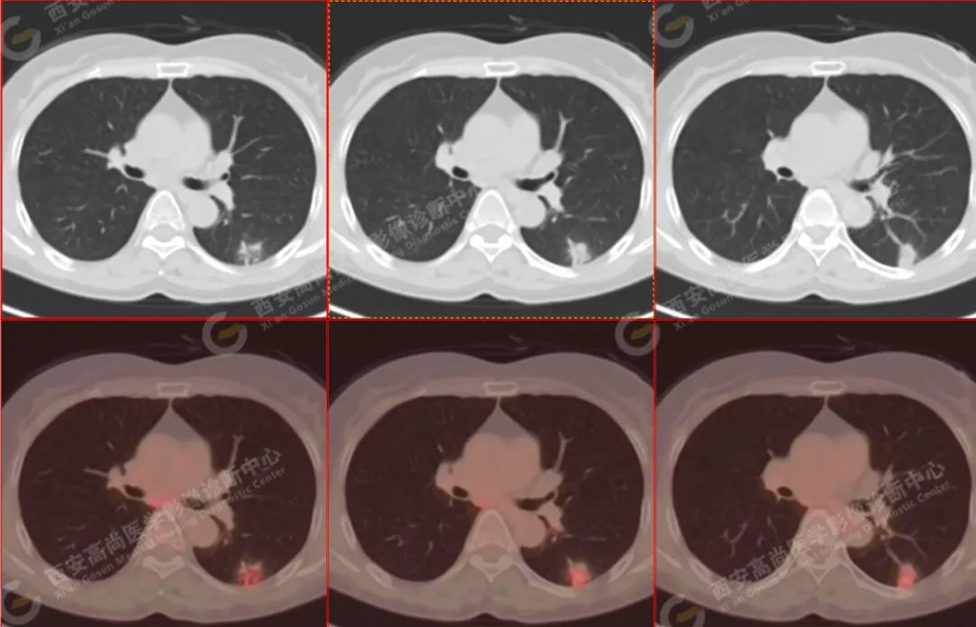 高尚病例：PET/CT 病例：原发性肺印戒细胞癌 1 例