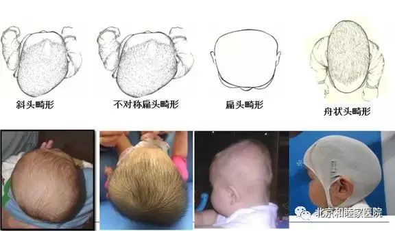 爸妈必看：头型也会影响宝宝发育