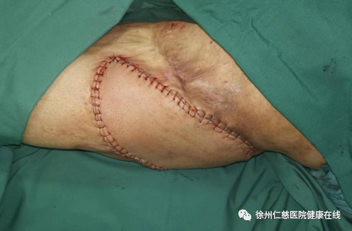 徐州仁慈医院超级显微外科技术加持，助力皮瓣修复