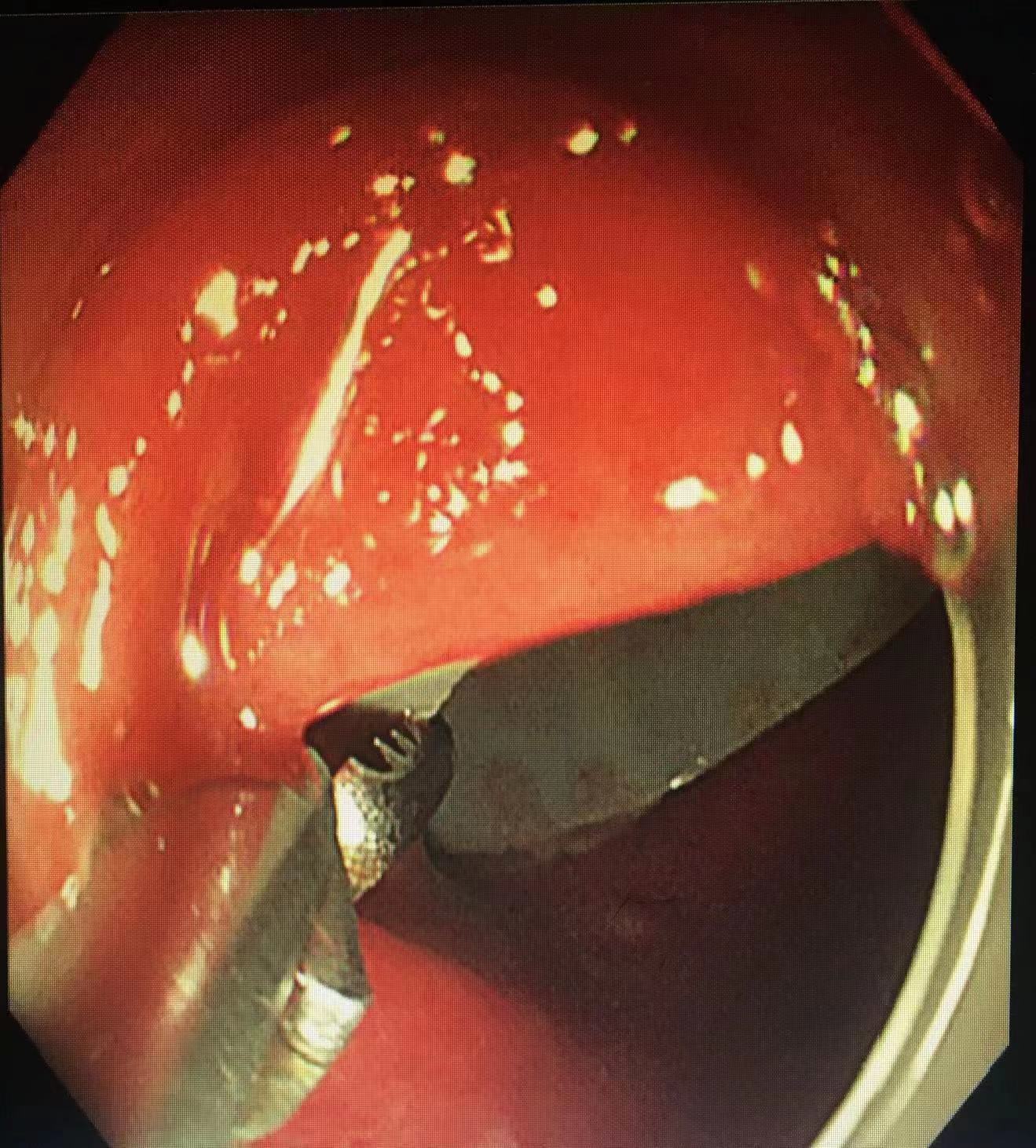 男子肠道异物嵌顿严重，荆门市中医医院内镜专家艰难排险