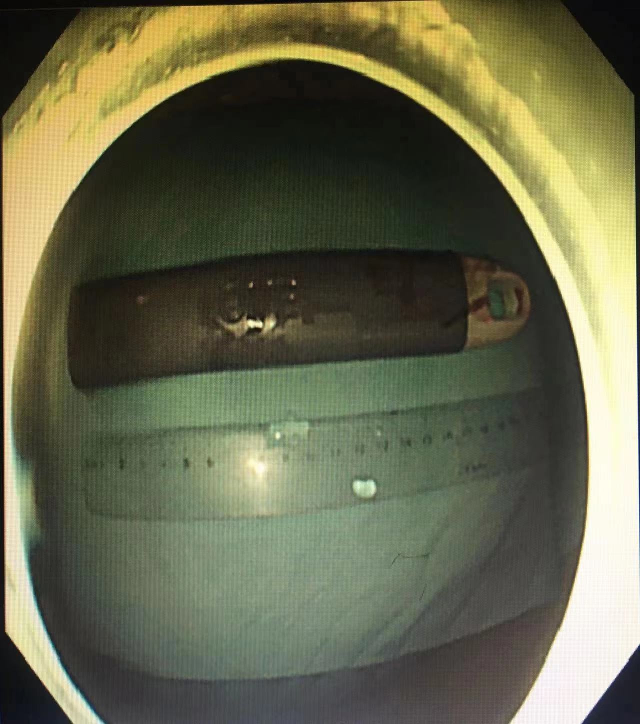 男子肠道异物嵌顿严重，荆门市中医医院内镜专家艰难排险