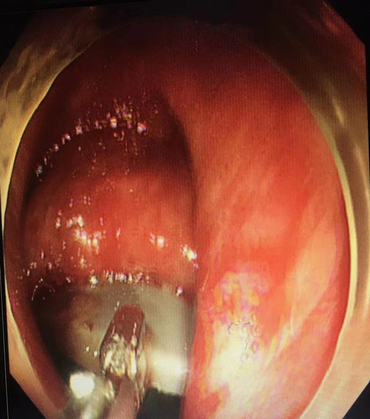 男子肠道异物嵌顿严重，荆门市中医医院内镜专家艰难排险