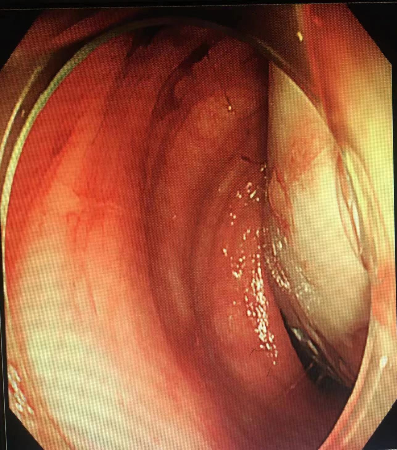 男子肠道异物嵌顿严重，荆门市中医医院内镜专家艰难排险