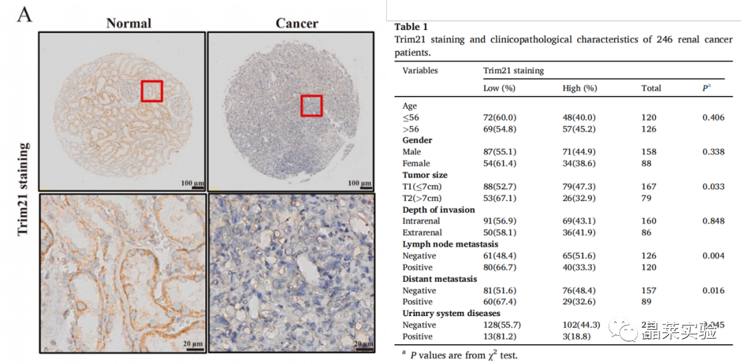 国自然热点泛素化研究之 “Trim21介导的HIF-1α降解减弱有氧糖酵解以抑制肾癌肿瘤发生和转移”