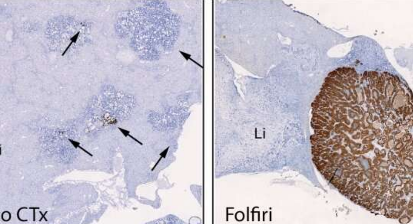化疗后结直肠癌复发的分子机制被揭示
