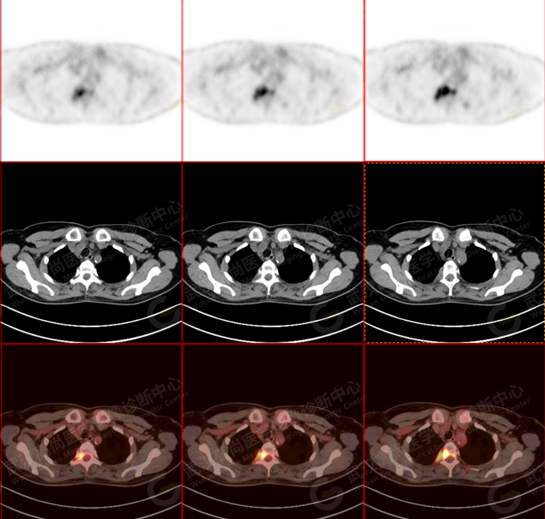 高尚病例：少见的原发性骨淋巴瘤 PET/CT 显像一例