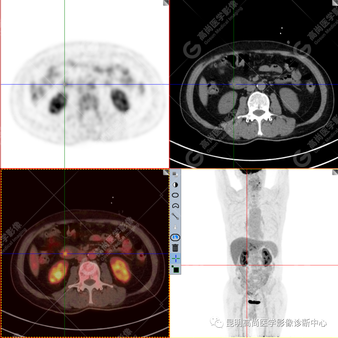 高尚病例：壶腹周围癌——十二指肠乳头癌一例