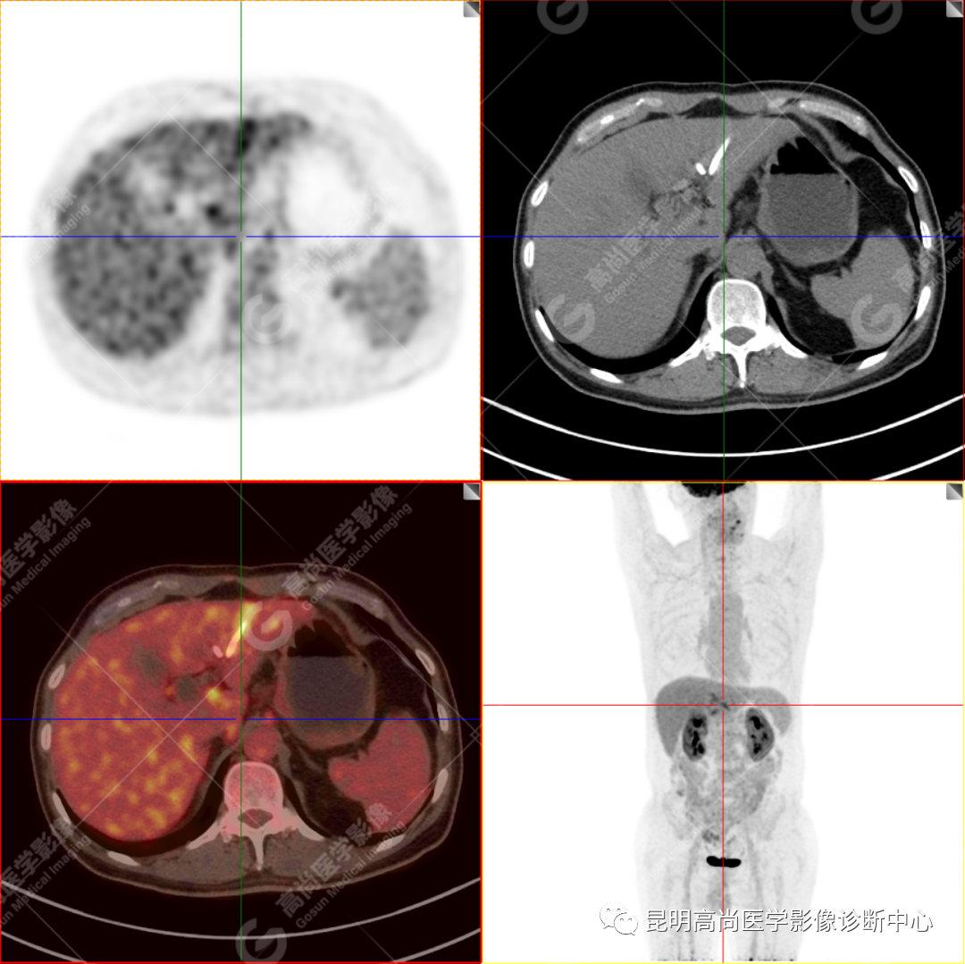 高尚病例：壶腹周围癌——十二指肠乳头癌一例
