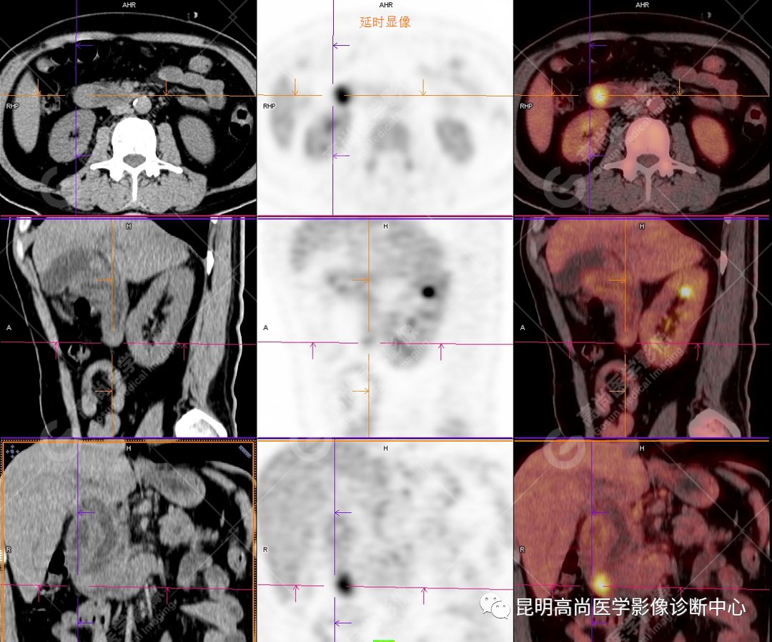 高尚病例：壶腹周围癌——十二指肠乳头癌一例