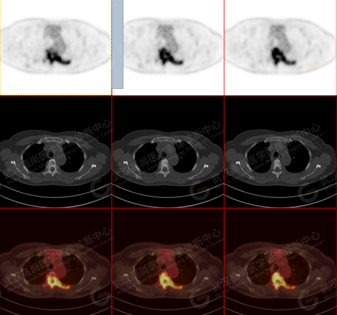 高尚病例：少见的原发性骨淋巴瘤 PET/CT 显像一例
