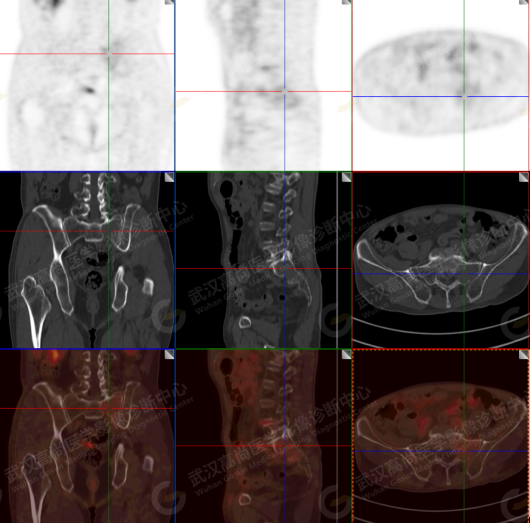血管母细胞瘤的影像学特征 | The Neurosurgical Atlas全文翻译 - 脑医汇 - 神外资讯 - 神介资讯