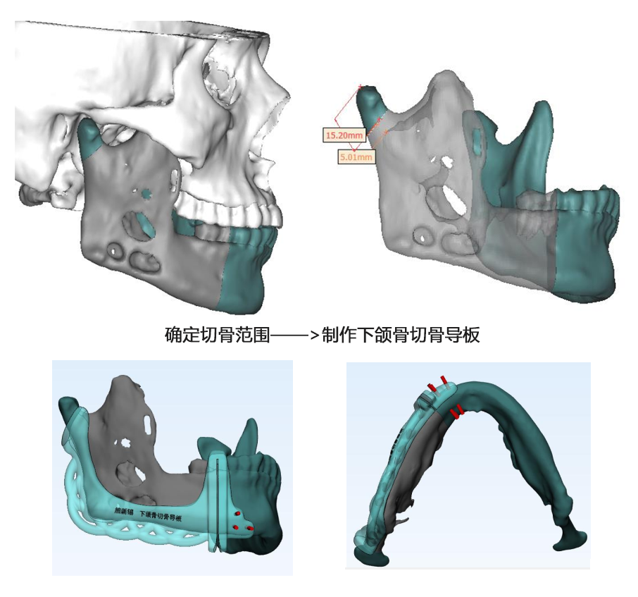 牙疼两年竟是癌？专家利用 3D 数字技术，取腿骨修复脸庞