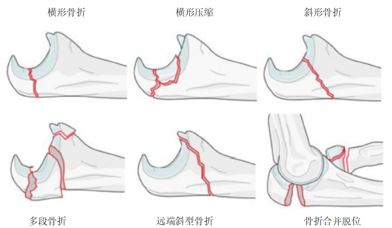尺骨近端骨折