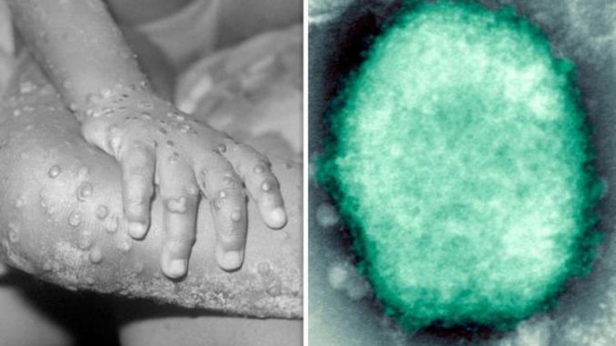 全球猴痘疫情持续发酵，71 国确诊 15378 例！