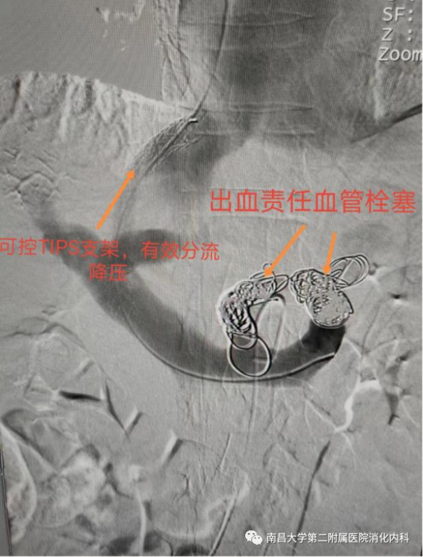 南昌大学二附院消化内科完成一例可控直径 TIPS 支架置入术