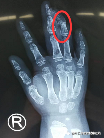 多方接力!徐州仁慈医院成功为五岁儿童断指再植