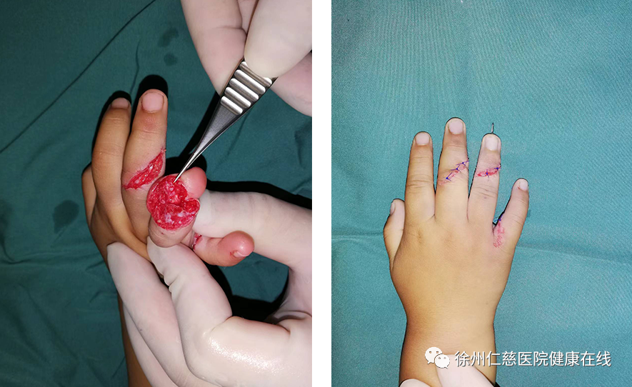 多方接力!徐州仁慈医院成功为五岁儿童断指再植