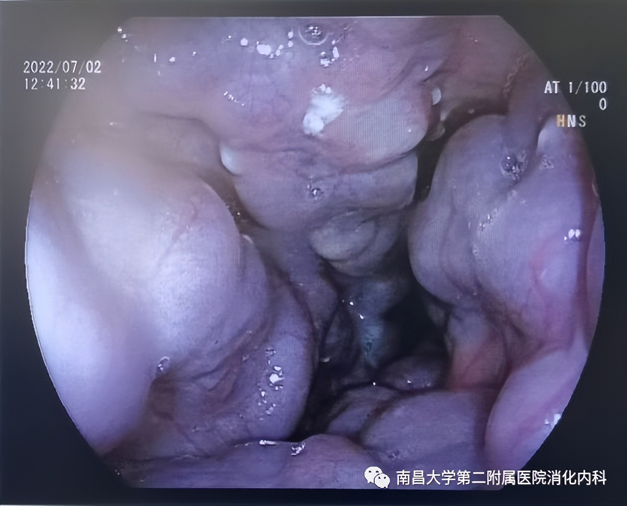 南昌大学二附院消化内科完成一例可控直径 TIPS 支架置入术
