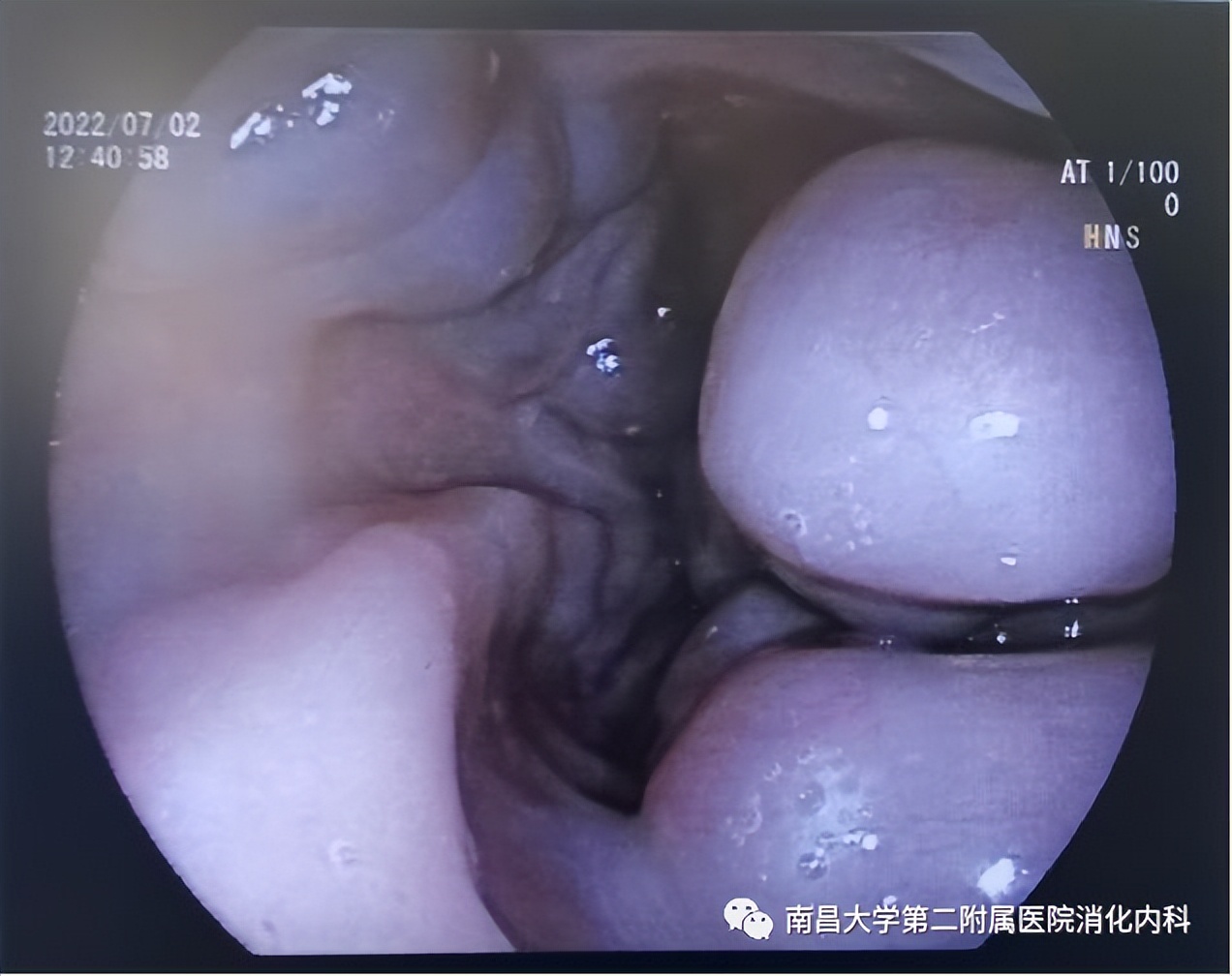 南昌大学二附院消化内科完成一例可控直径 TIPS 支架置入术