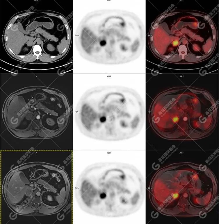 高尚病例：PET/CT-MR 多模态显像：嗜铬细胞瘤 1 例