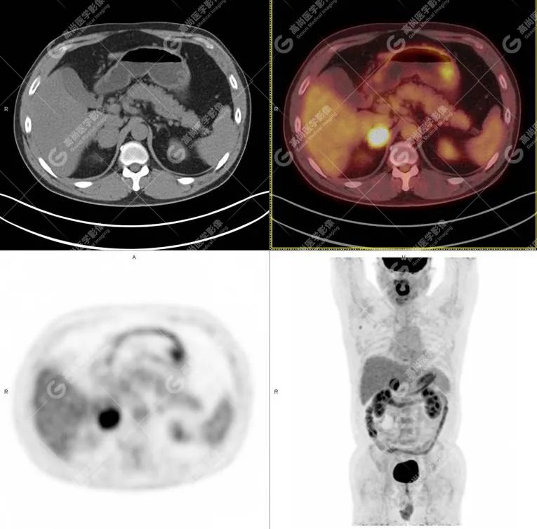 高尚病例：PET/CT-MR 多模态显像：嗜铬细胞瘤 1 例