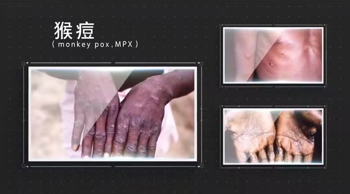 一篇文章教你了解猴痘